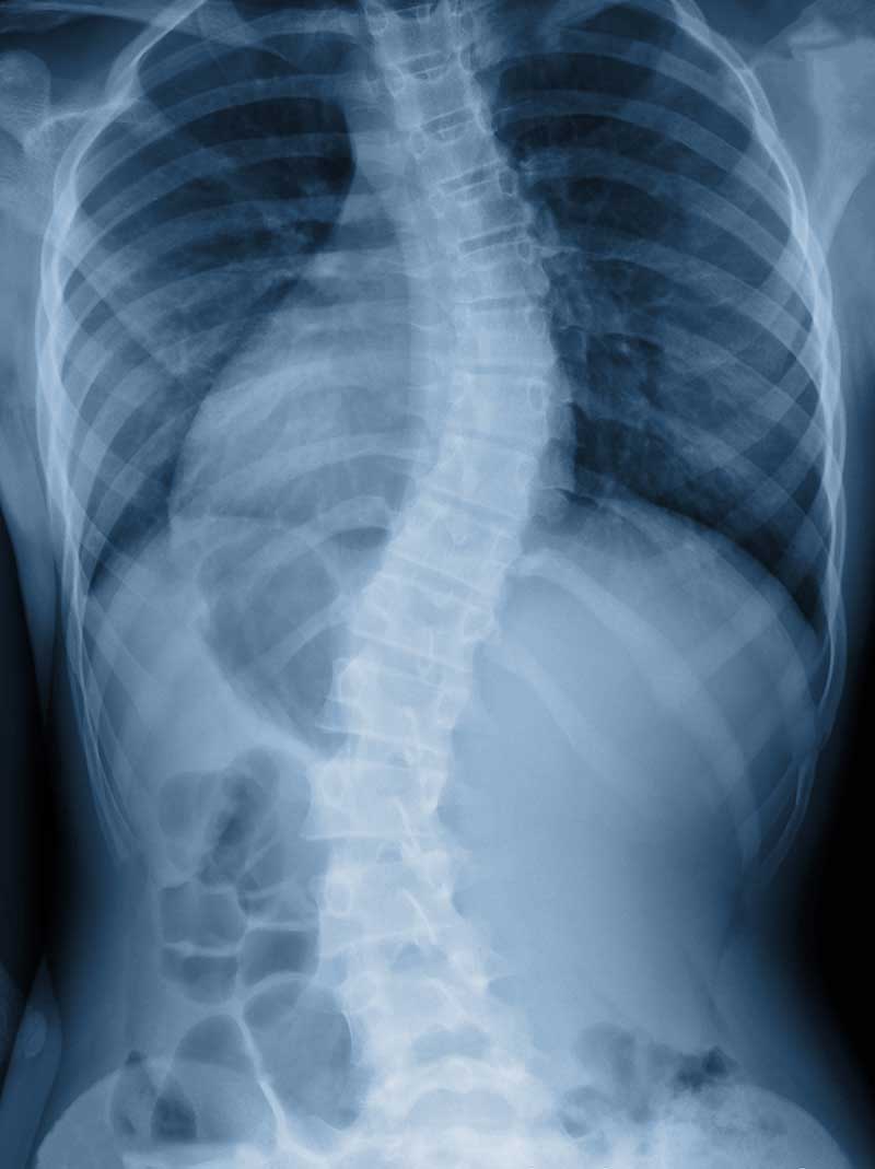 Scoliosis Alpharetta, GA